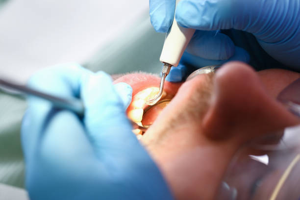 Best Emergency Tooth Extraction in Goldenrod, FL